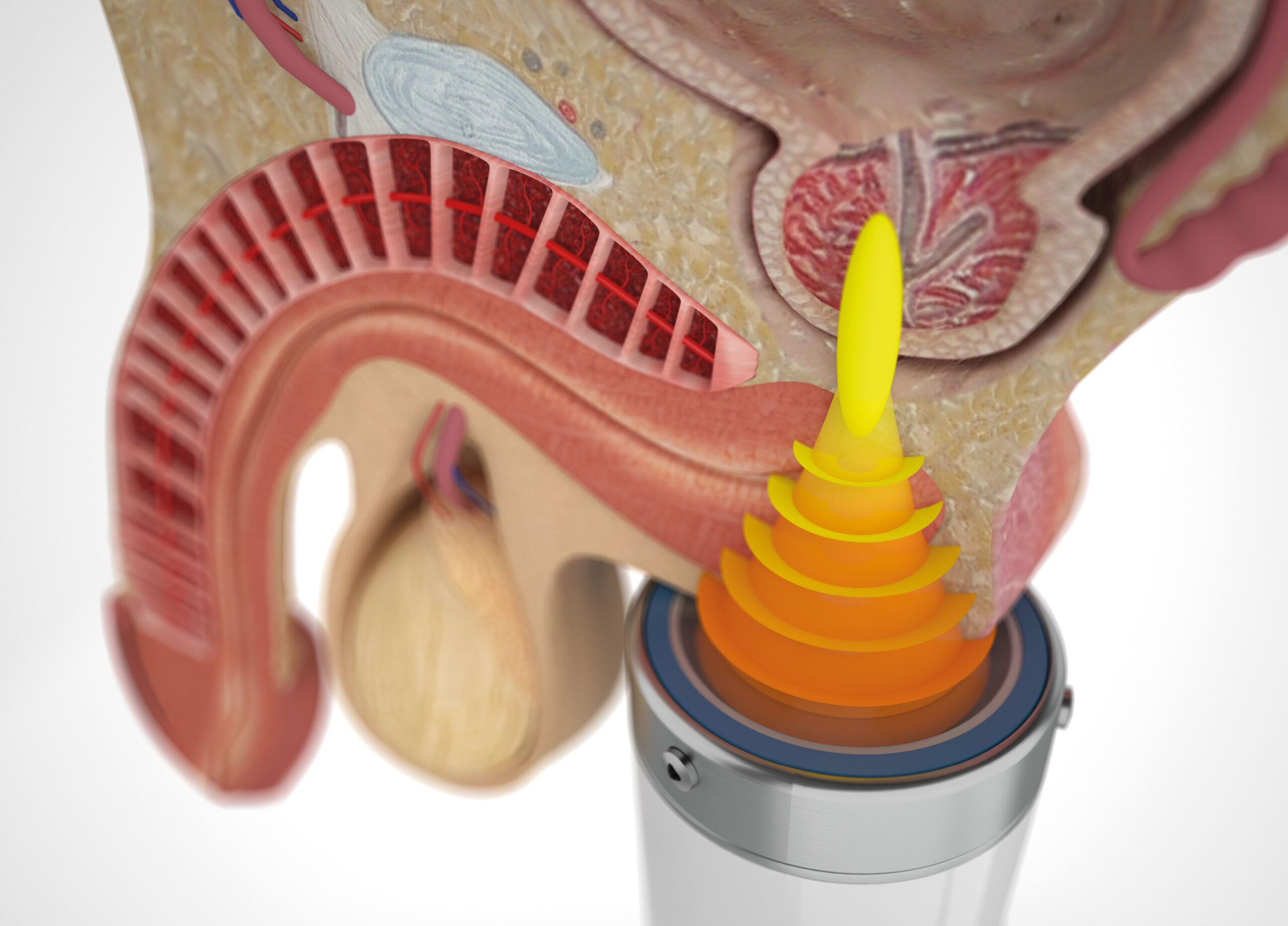 Shockwave bij chronisch bekkenpijn syndroom_prostatitis Shockwave bij chronisch bekkenpijn syndroom_prostatitis